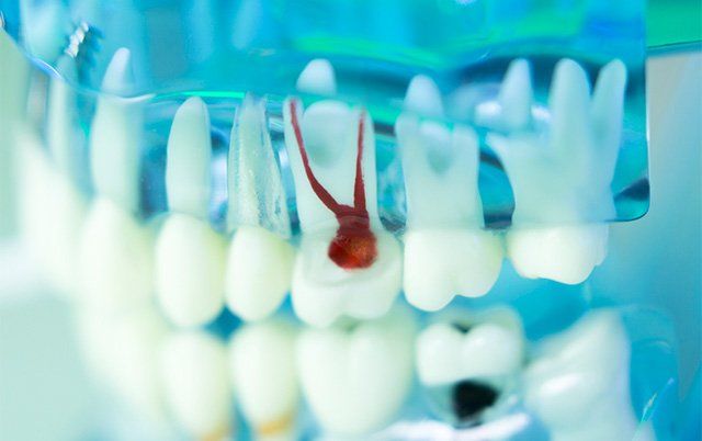 root canal, Potomac Falls Family Dentistry