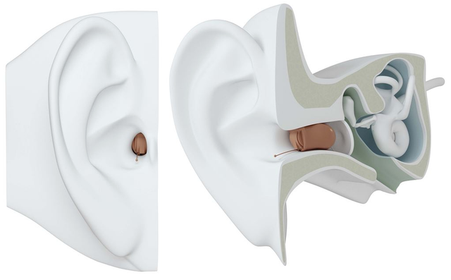 Explore Signia Hearing Aids: Advanced Solutions in Florence