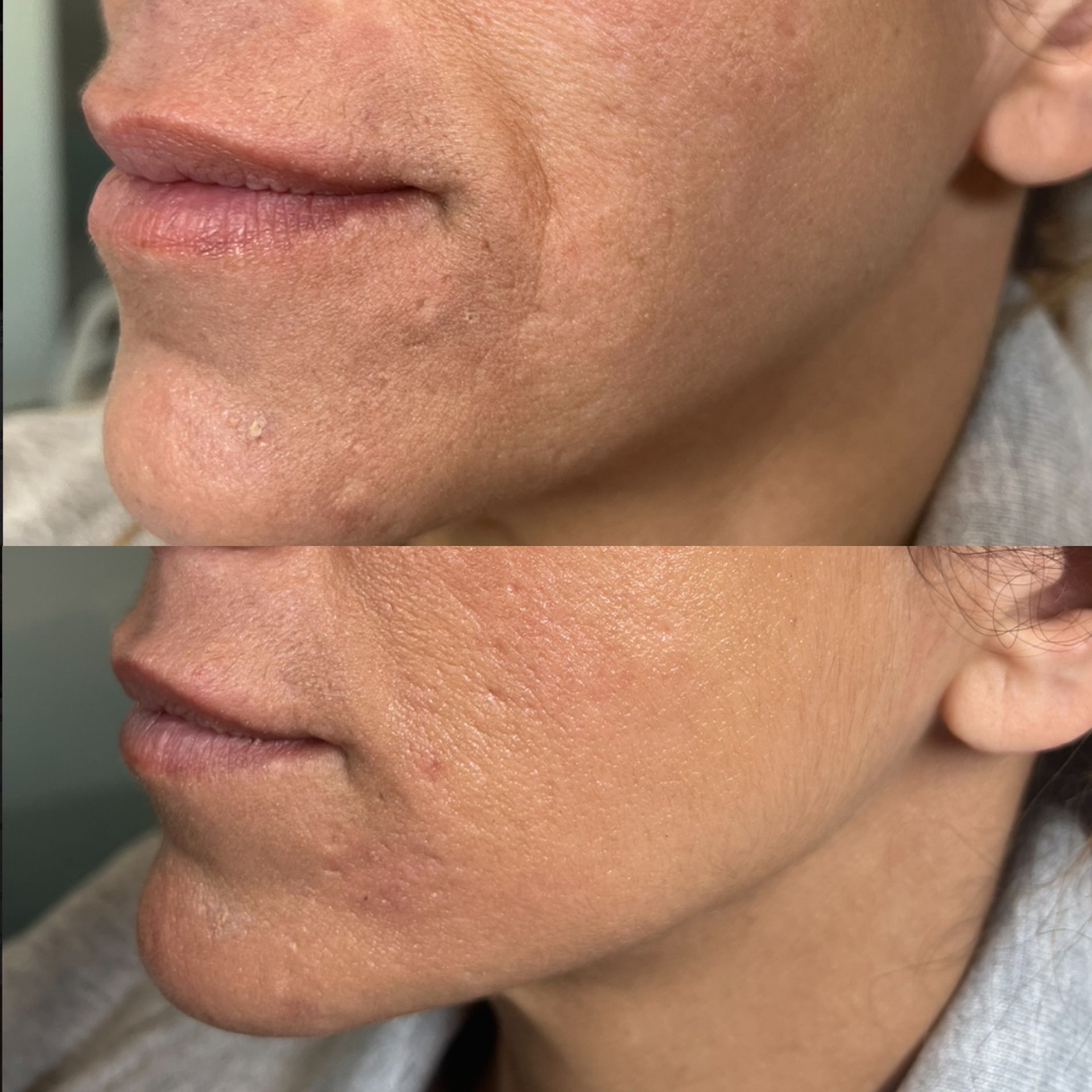 Before and after of a woman's face showing improved skin texture and reduced acne scars.