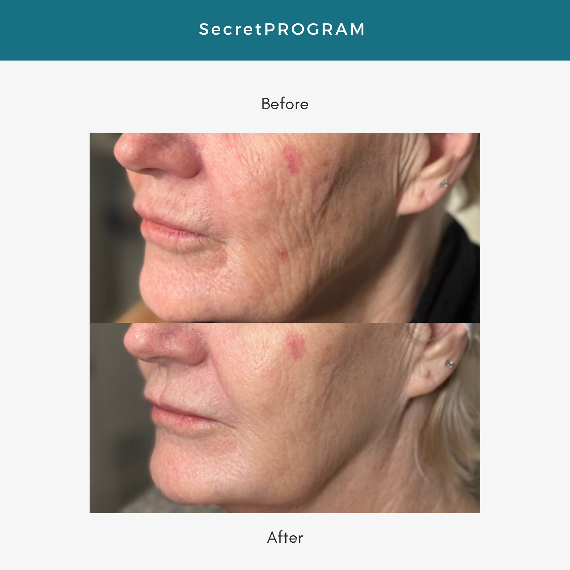 Before and after comparison of neck wrinkles. Left shows wrinkles, right shows smoother skin after 3 treatments.