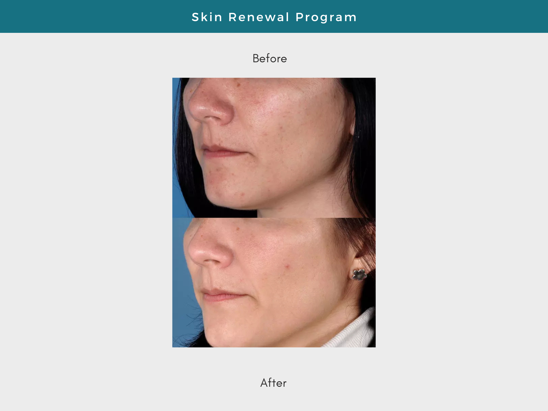 skin, microneedling, skincare, ZO, ZO skin health, uneven skin, anti-aging, results, collagen, Microneedling in Burlington, Microneedling in Ancaster, Microneedling in Hamilton, Microneedling in Oakville