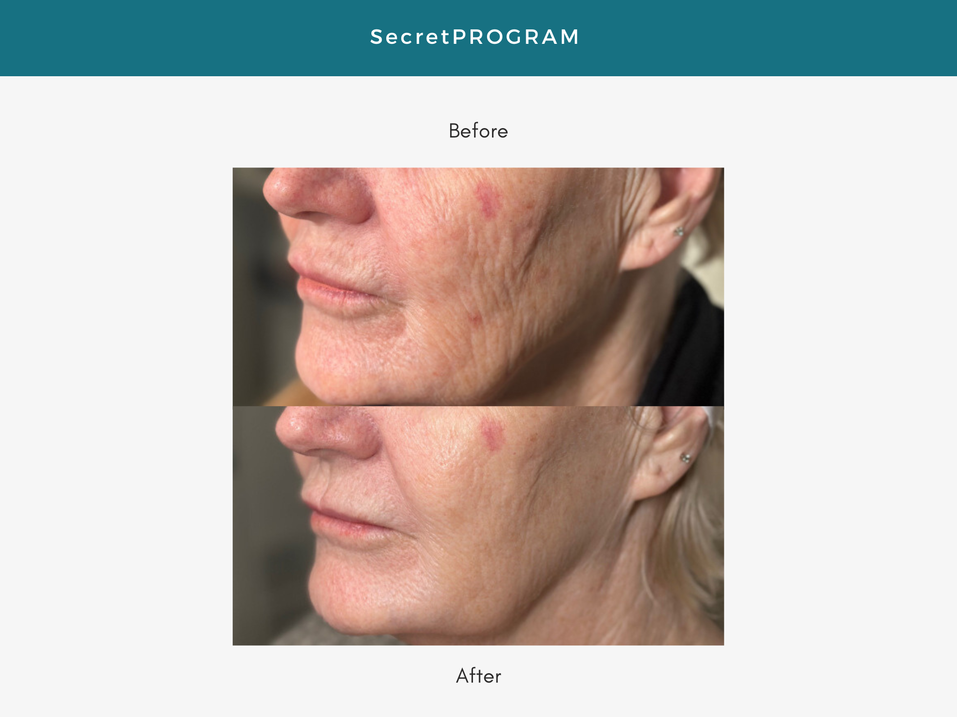 Secretpro, laser, redness, dark spots, Medical Spa in Burlington, real results, wrinkle reduction, luxury medical spa