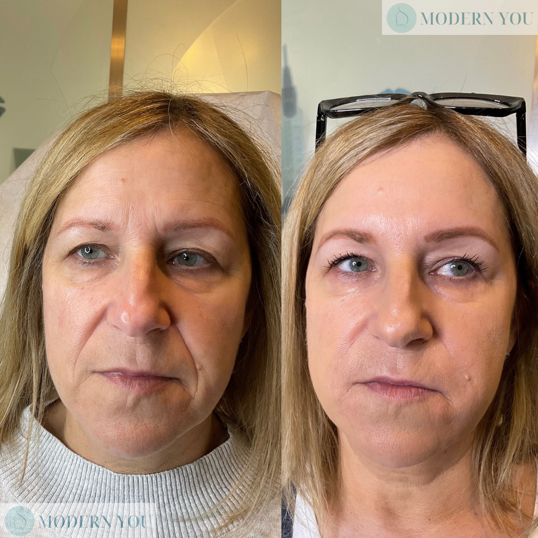 Before and after photos of woman's face; left side is before cosmetic work, right side after.