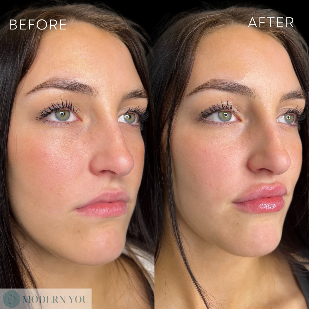 Before and after photos showing lip filler. The woman’s lips are fuller in the after photo.