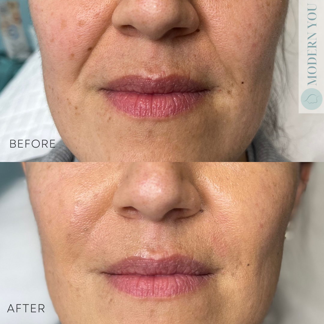 Before and after photos of a person's face, showing a reduction in wrinkles around the mouth and improved skin texture.