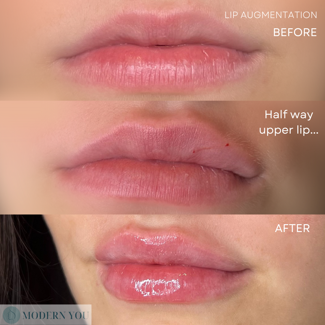 Lip augmentation comparison: before, half-way, and after showing increased lip volume and fullness.