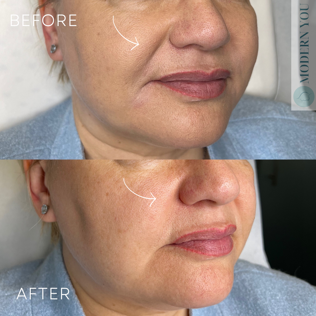 Side-by-side comparison: Woman's face shows reduction of wrinkles in cheeks after cosmetic procedure.