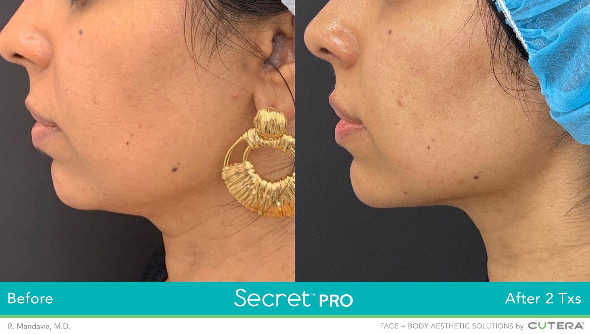 skin tightening laser before and after burlington