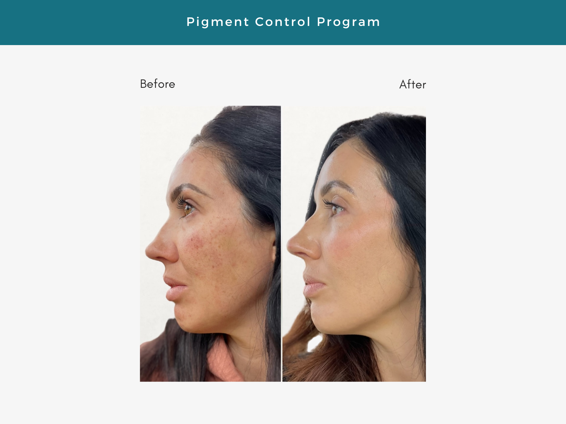 laser treatment for enlarged pores, laser treatment for skin texture, lasers for dark skin, target stubborn pigmentation, pigment control, 