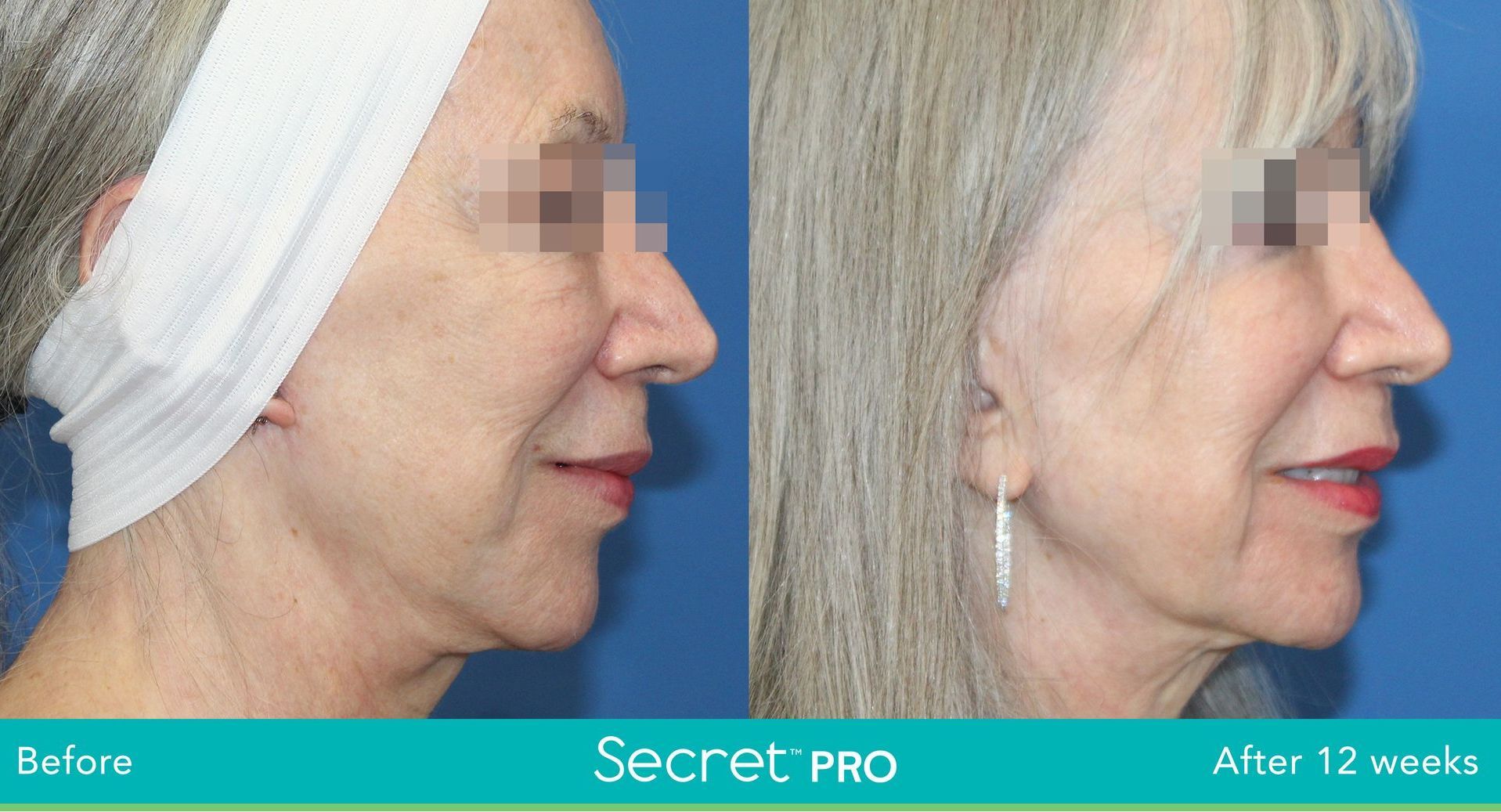Secret pro, anti aging treatment, microneedling before and after