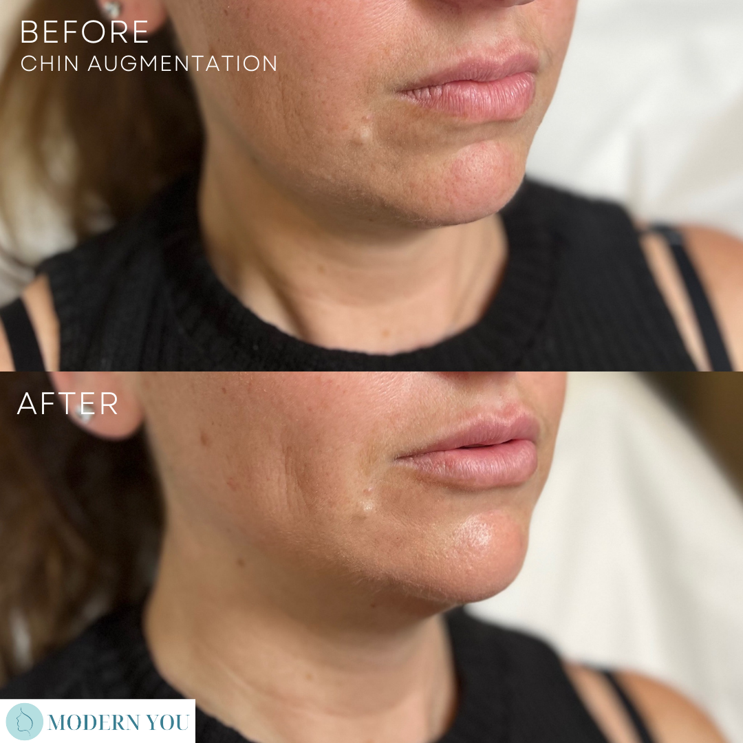 Comparison of a woman's face before and after chin augmentation, showing a more defined chin.