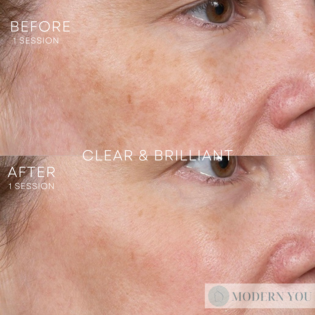 Modern you medical aesthetics clear and brilliant before and after