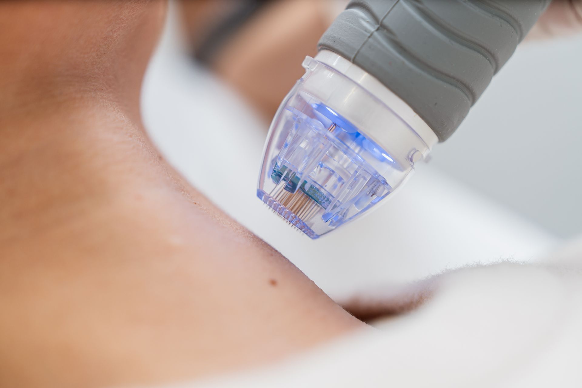 Close-up of a person's neck receiving a microneedling treatment. A device with tiny needles is pressed against the skin.