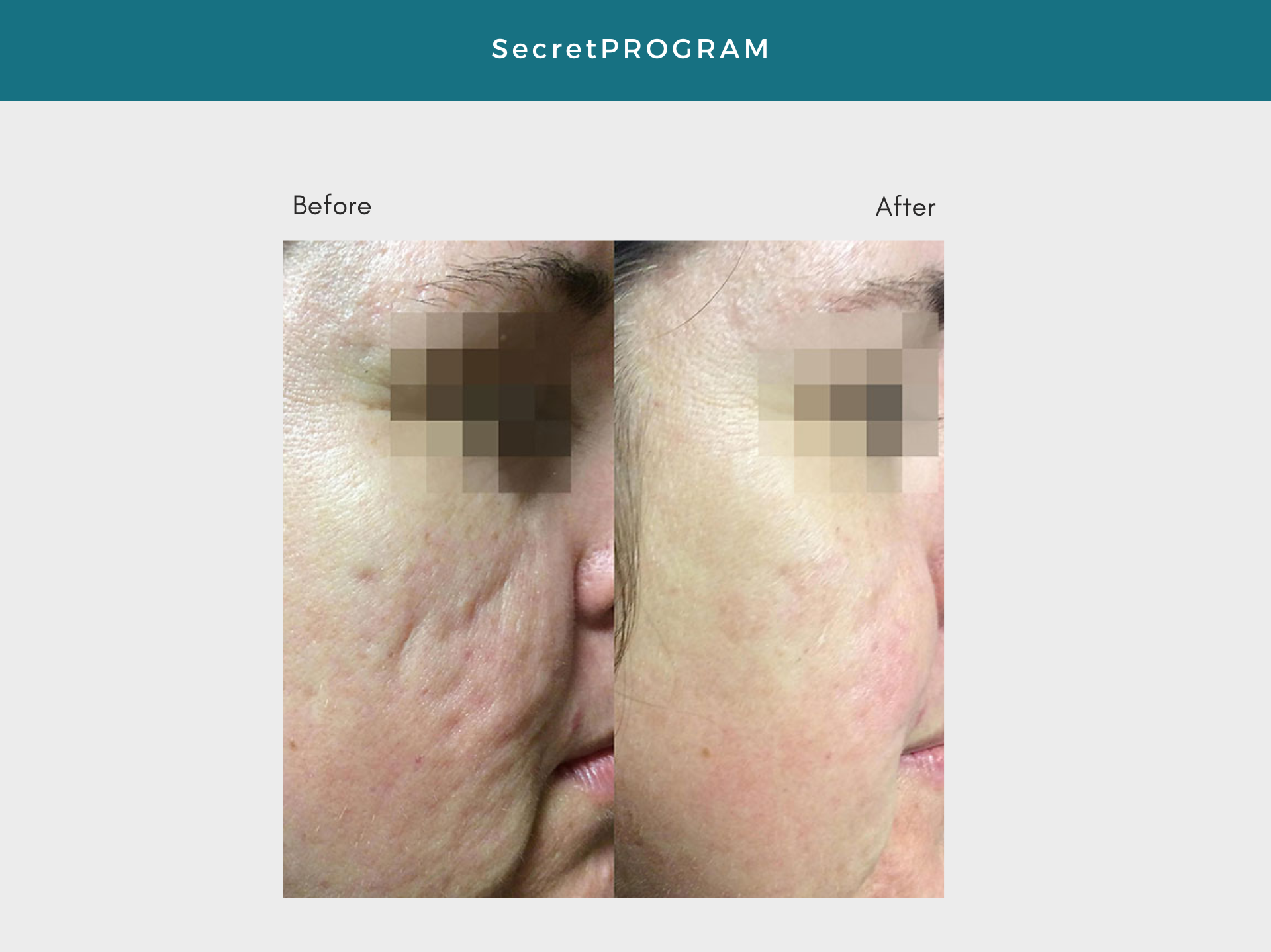 secretpro, lasers for pigment, pigment control, CO2, laser, anti aging treatment, results driven medical spa, med spa