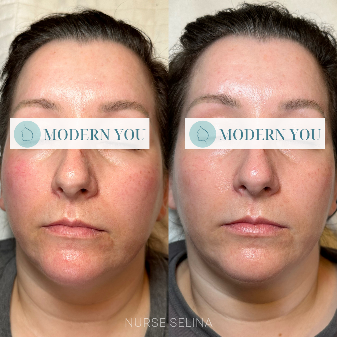 treatment for redness before and after