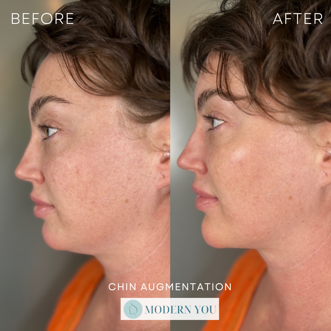 Chin filler before and after at modern you medical aesthetics