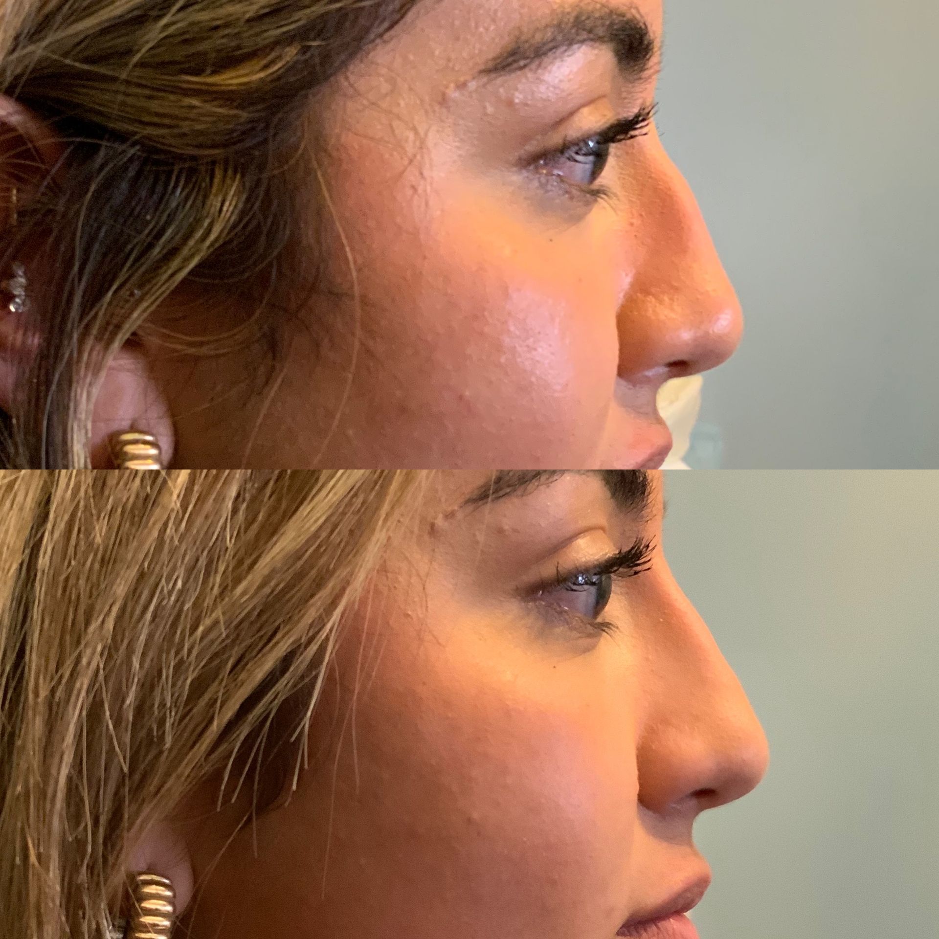 Before and after profile views of a woman's nose. Top: slightly crooked. Bottom: straightened.