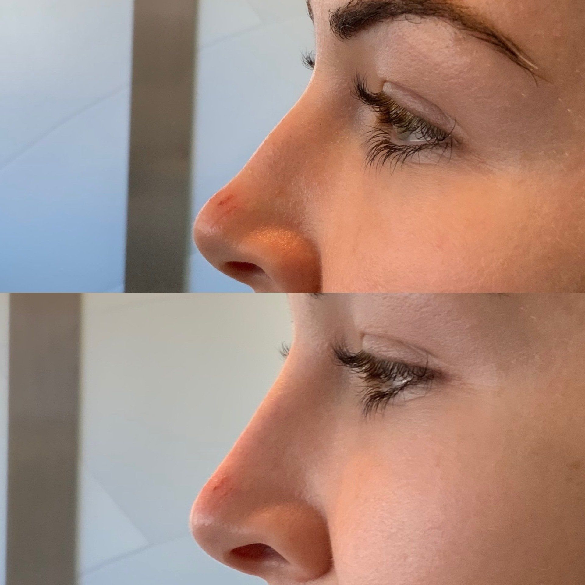 Before and after profile view of a woman's nose, with visible changes in shape after a procedure.