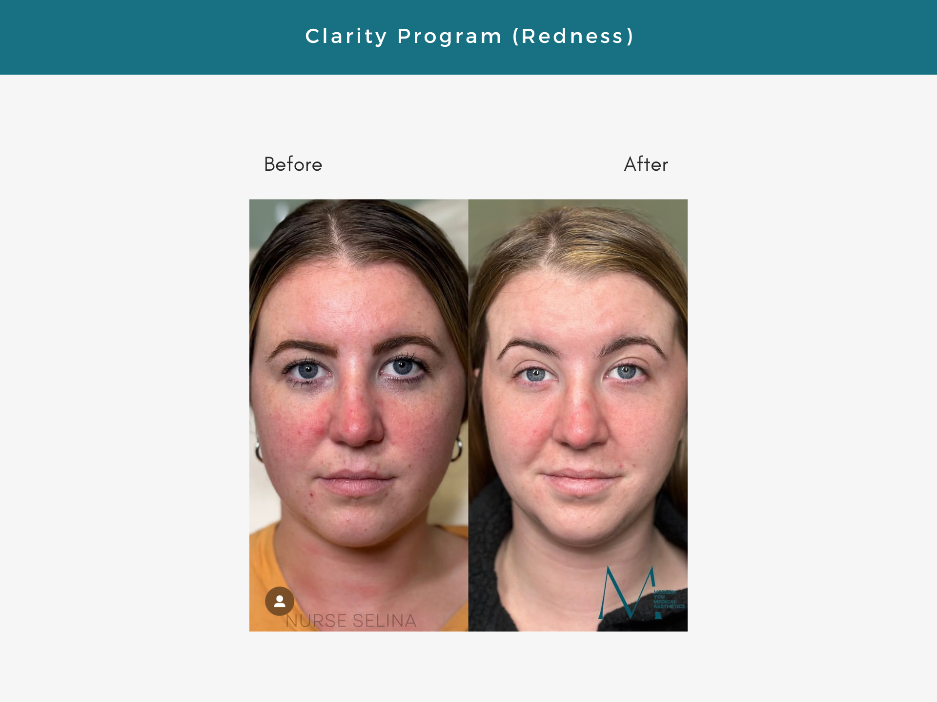 Before and after photos of a woman's face, showing a reduction in facial redness after a clarity program.
