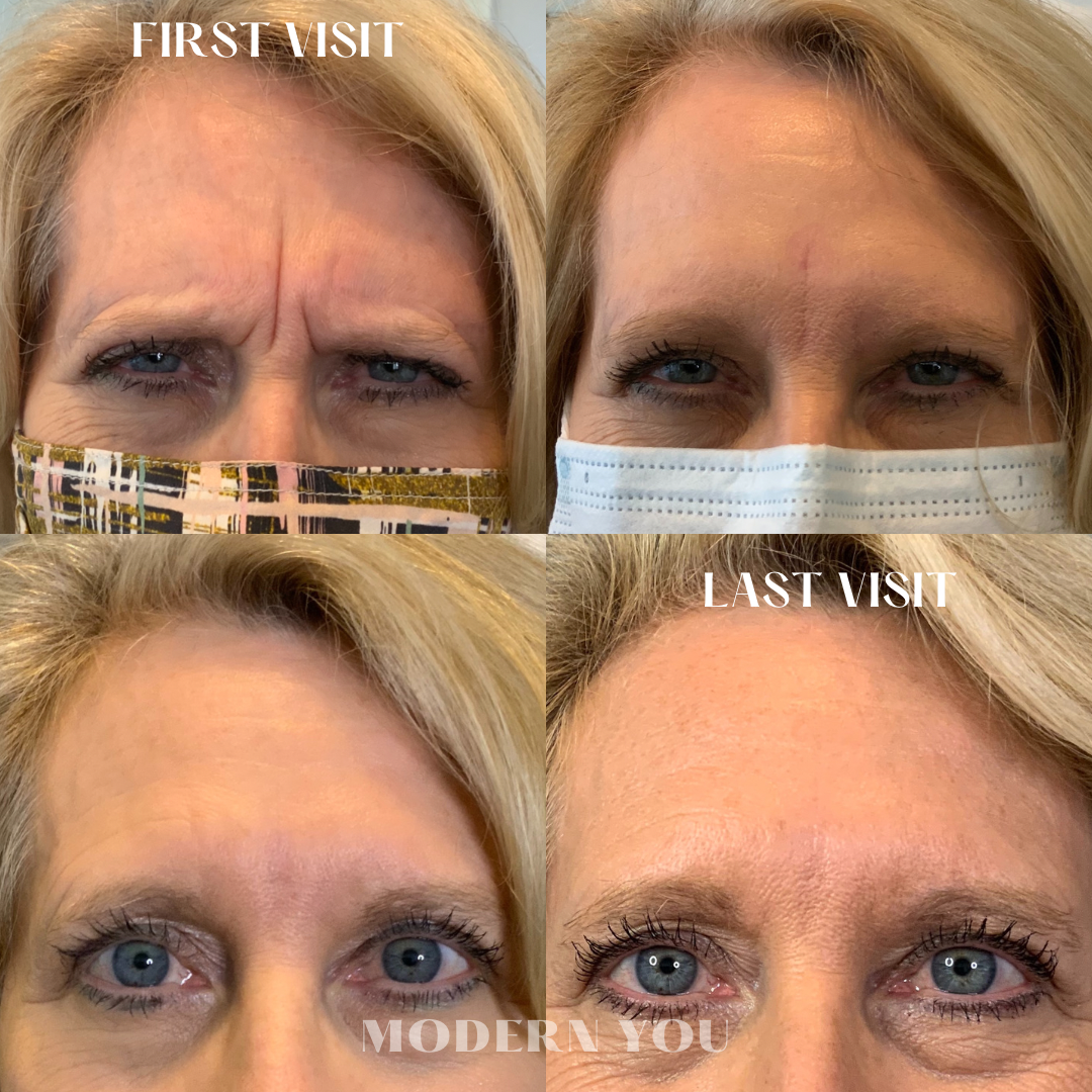 Before and after shots of a woman's forehead, showing a reduction in wrinkles after treatments.