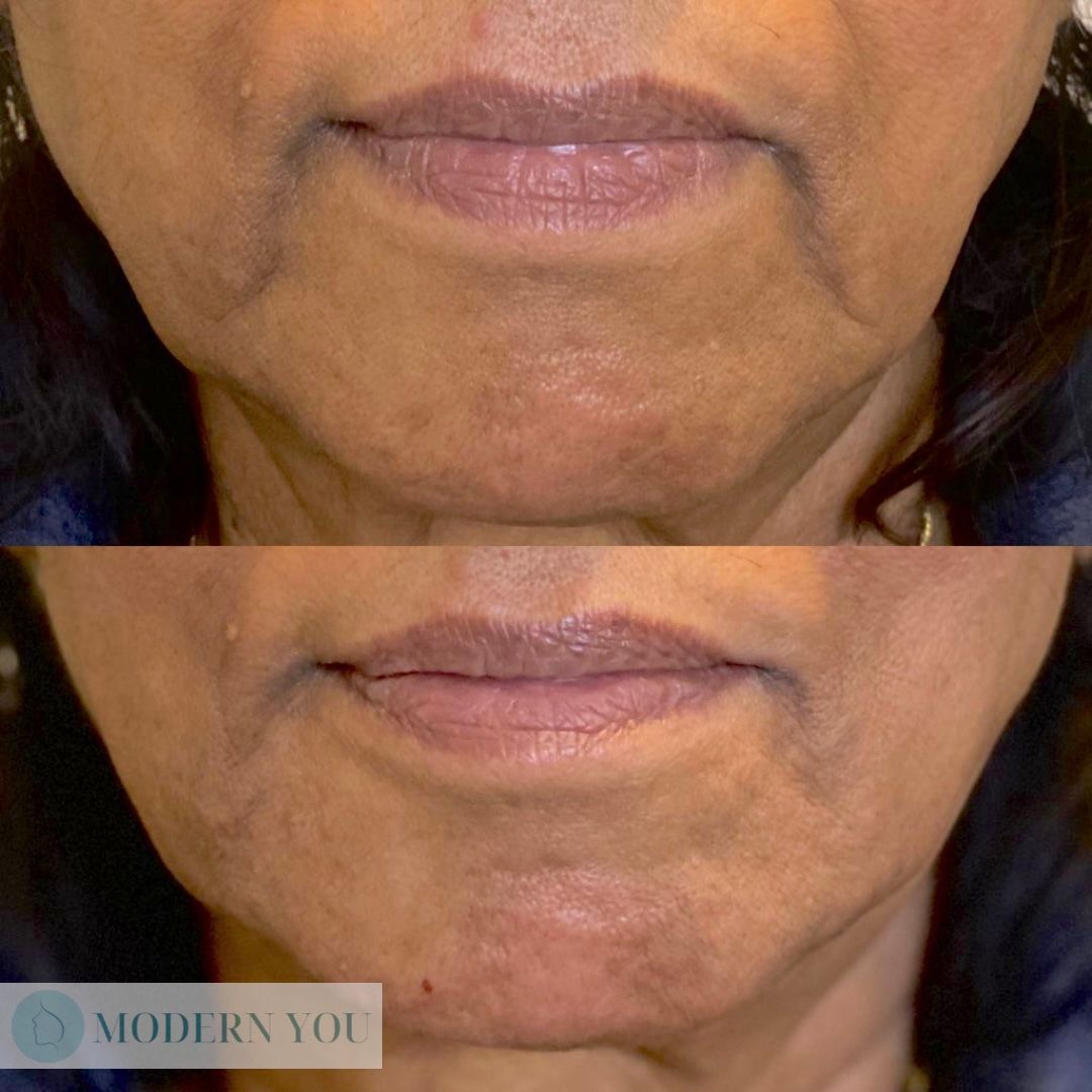 Before and after photos of a woman's lower face, showing reduced wrinkles and smoother skin.