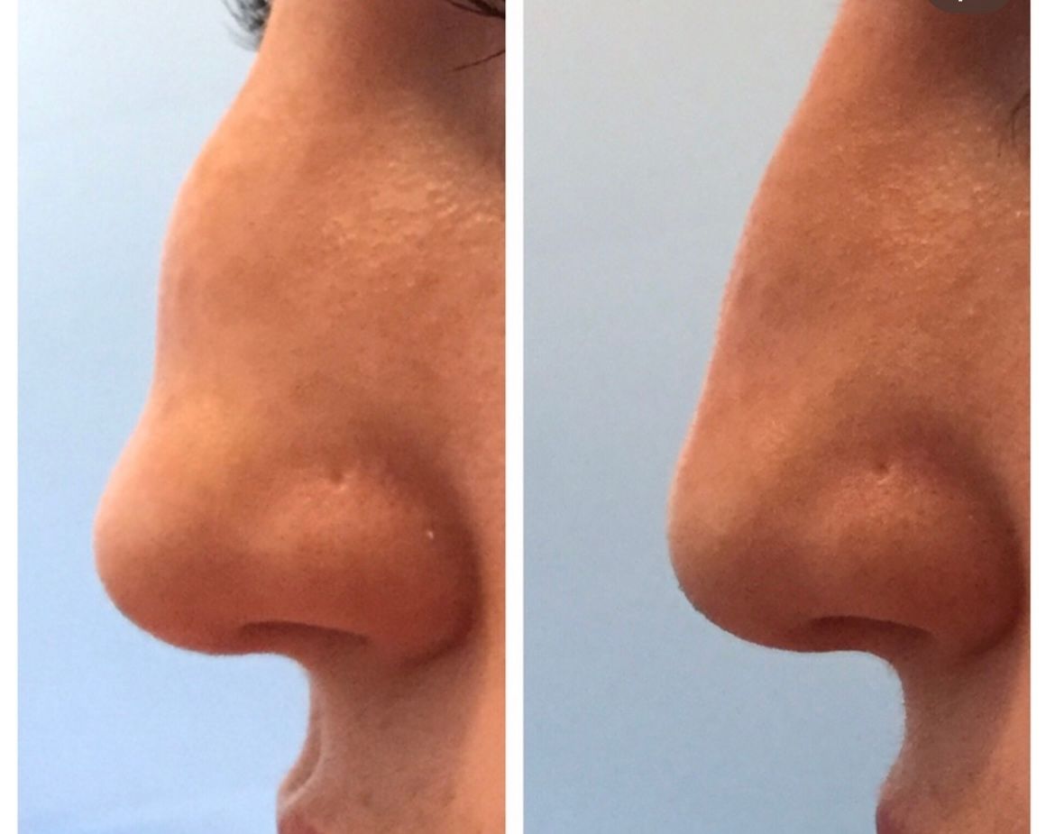 Profile view of a nose before and after rhinoplasty, showing a reshaped nose with a straighter bridge.