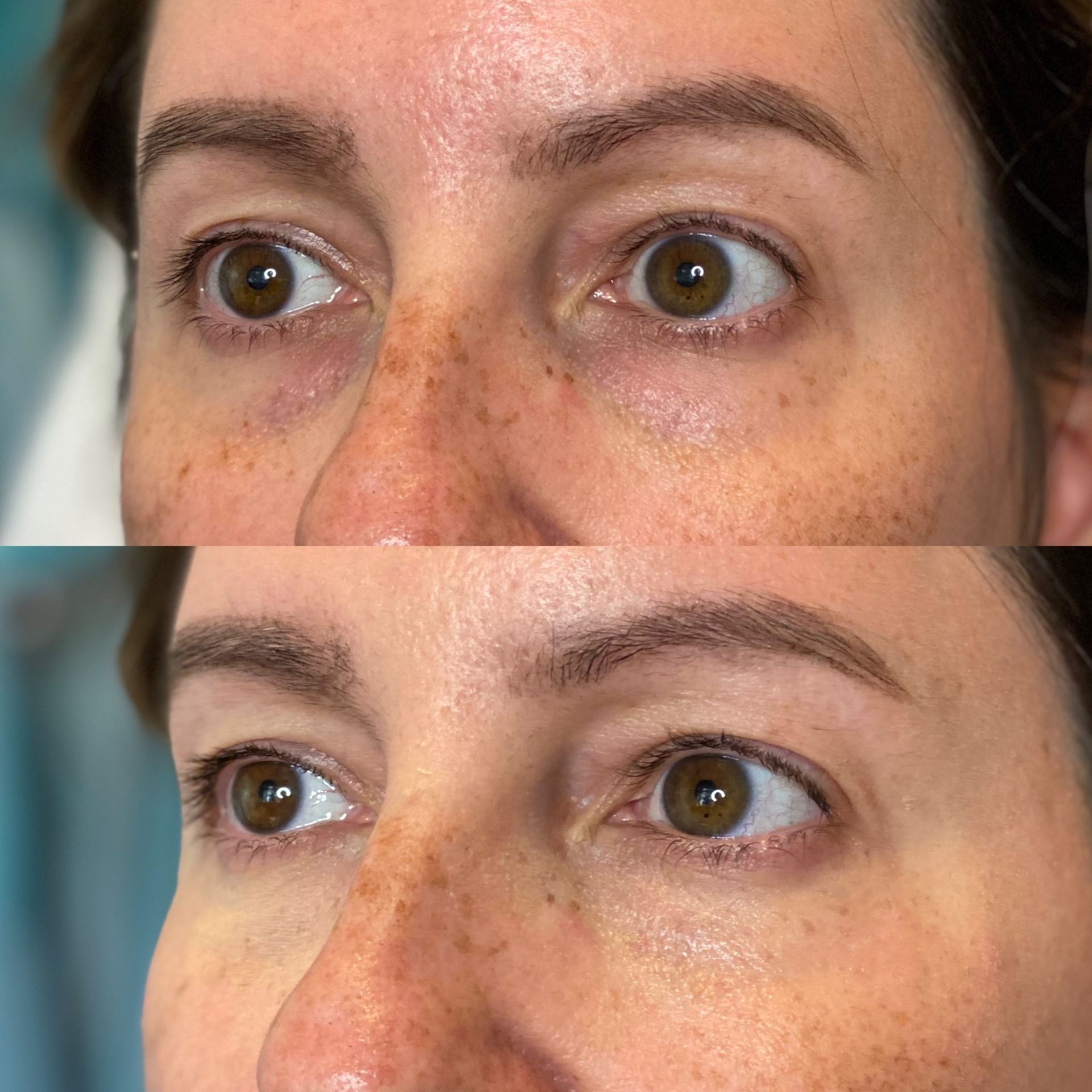 Before and after of a woman's eyes. The bottom photo shows less under-eye darkness.