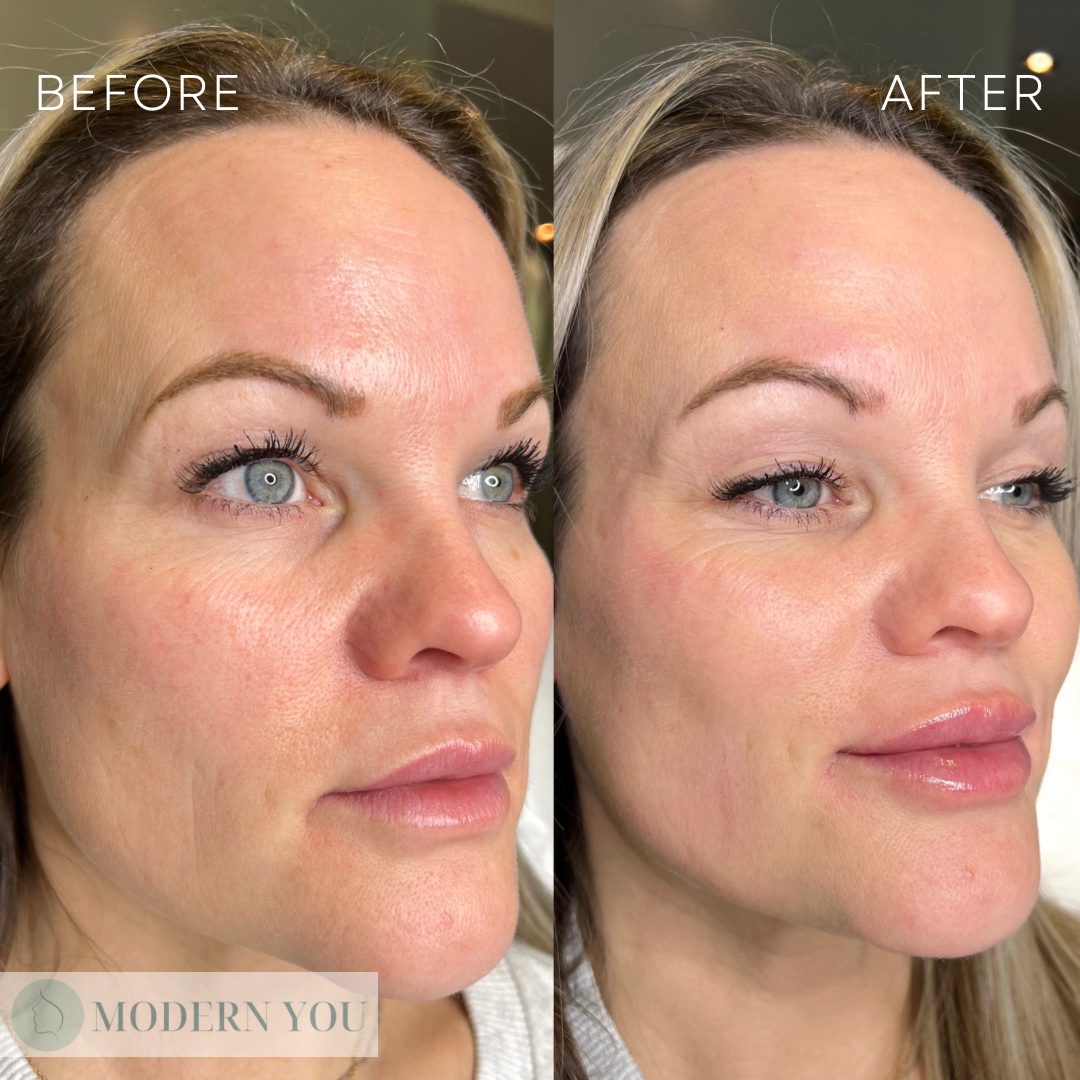 Before and after photos of a woman's face; looks like the after photo includes lip filler and cheek enhancement.