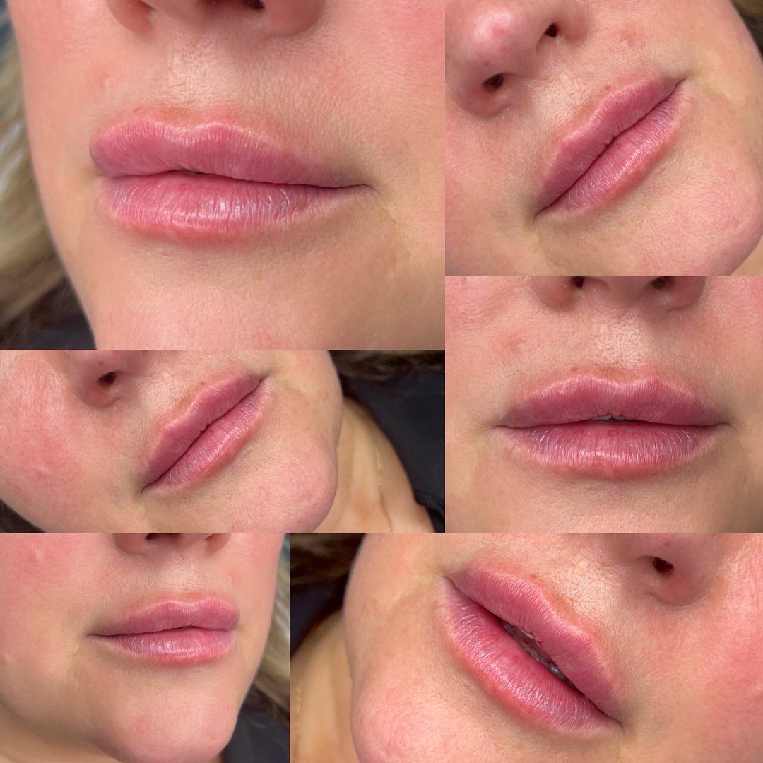 Close-up of a person's lips. The lips are enhanced, full, and pink, shown in various angles.