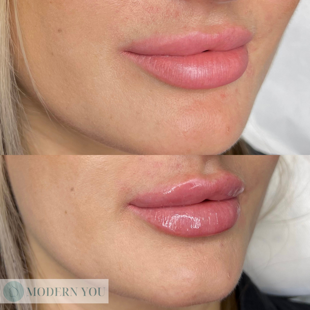Before and after lip filler photos; plump, pink lips. Top photo shows lips before; bottom, fuller after.