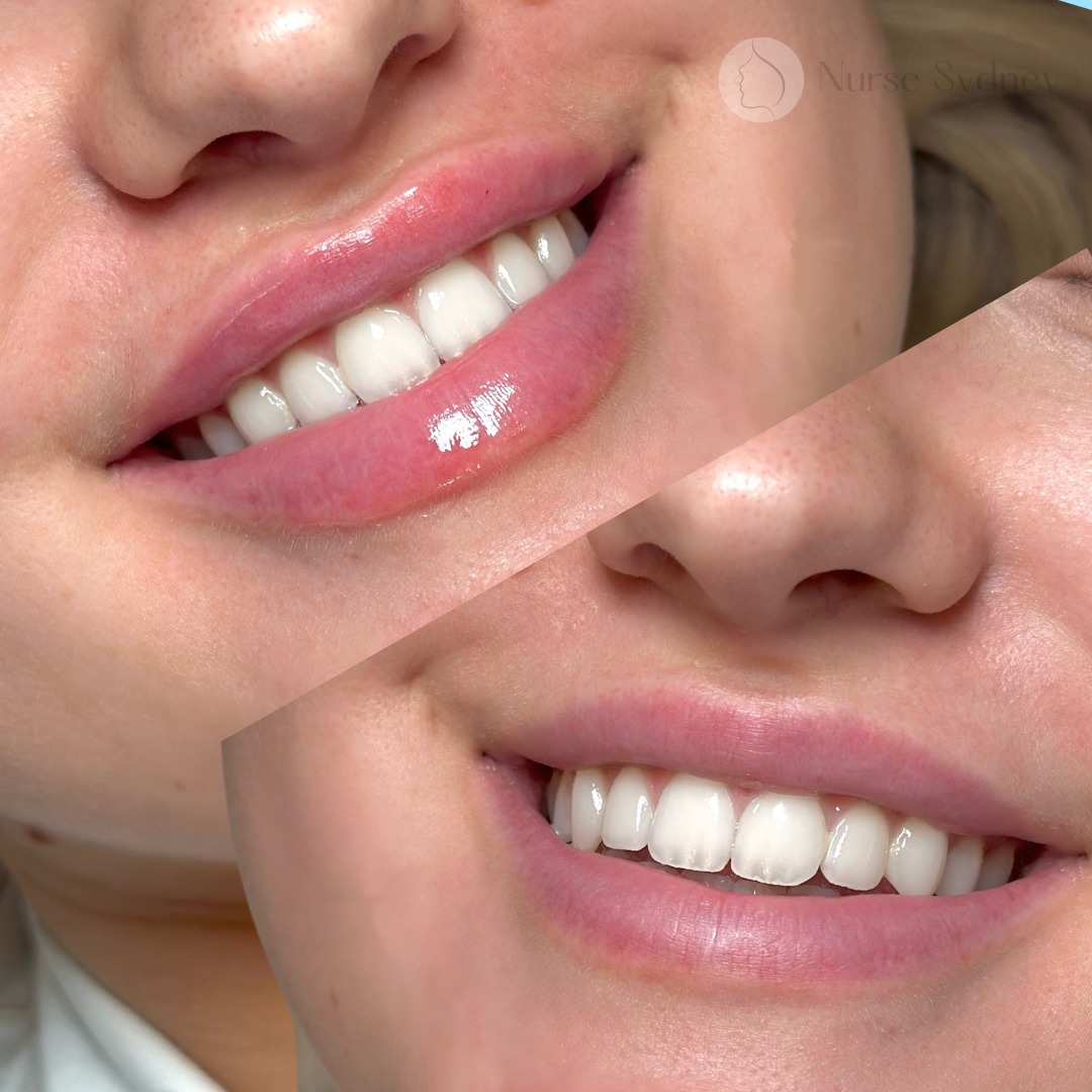 Two close-up smiling faces. One shows plump, glossy lips and bright teeth; the other, more subtle, healthy lips and teeth.