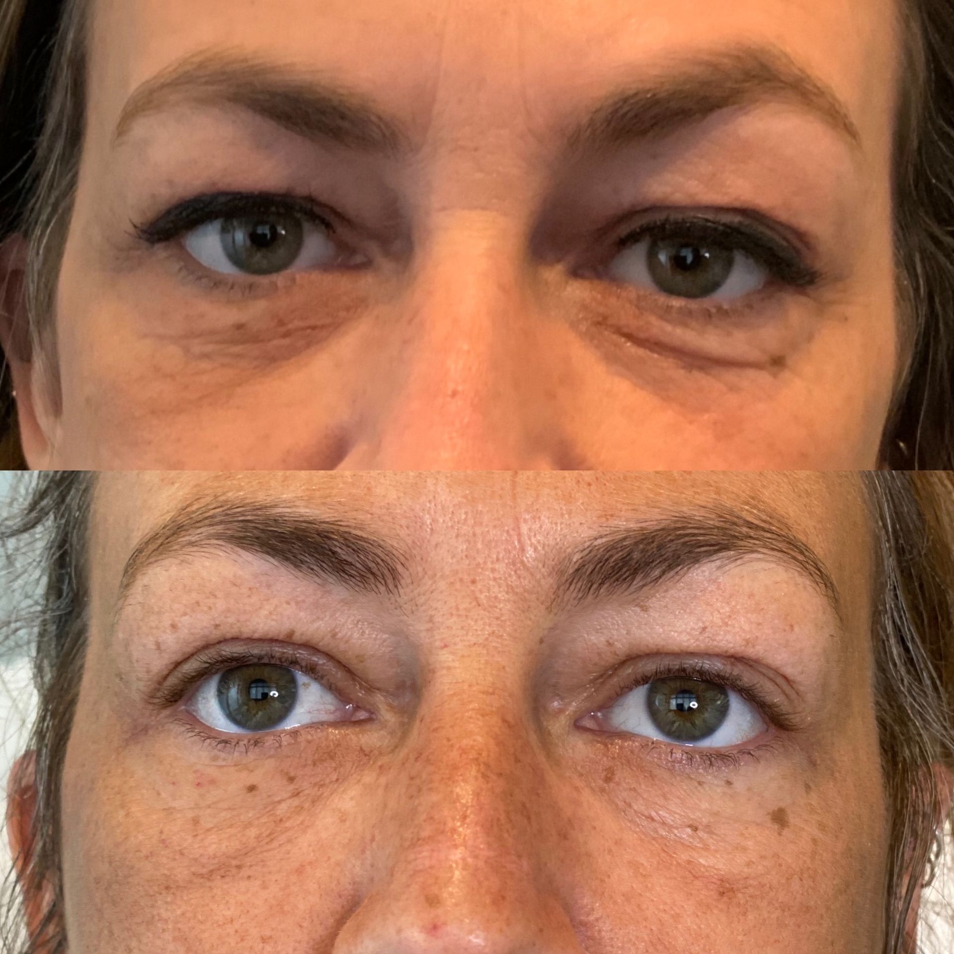 Before and after of woman's eyes: top image shows dark circles, bottom image shows reduction in circles and improved appearance.
