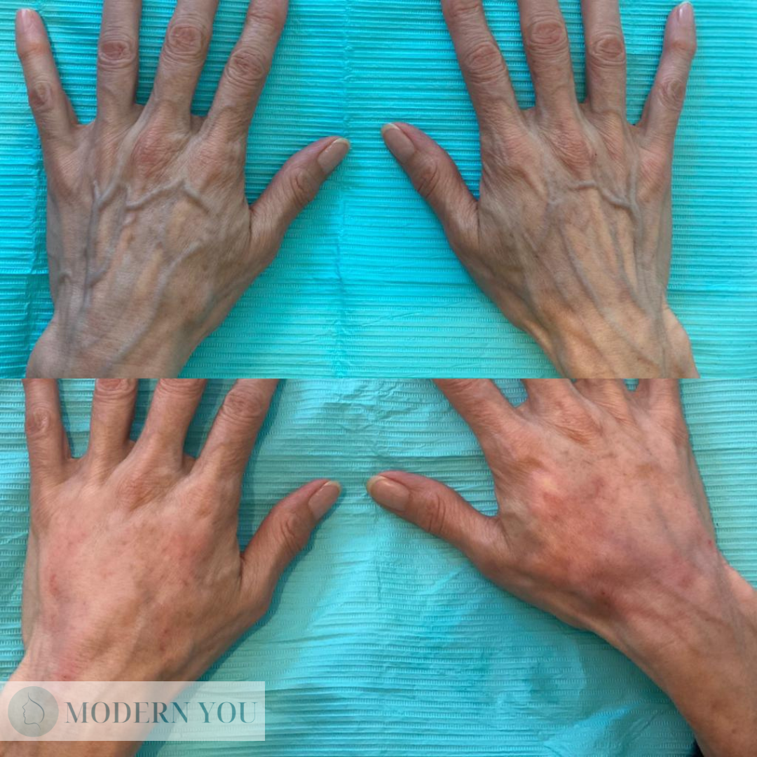 Top: hands showing prominent veins. Bottom: hands with less visible veins.