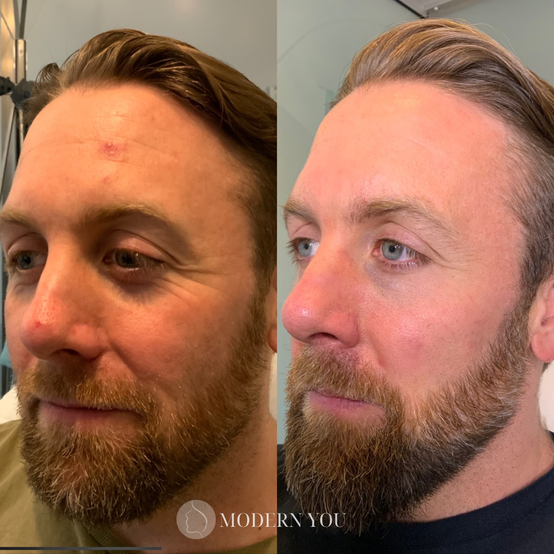 Man's face before/after cosmetic treatment. Wrinkles reduced, skin appears smoother, brown beard, fair skin.
