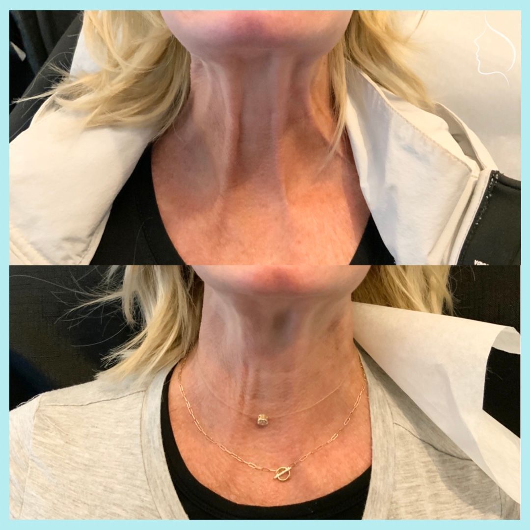 Before-and-after view of a woman's neck showing reduced lines and wrinkles after a cosmetic procedure.