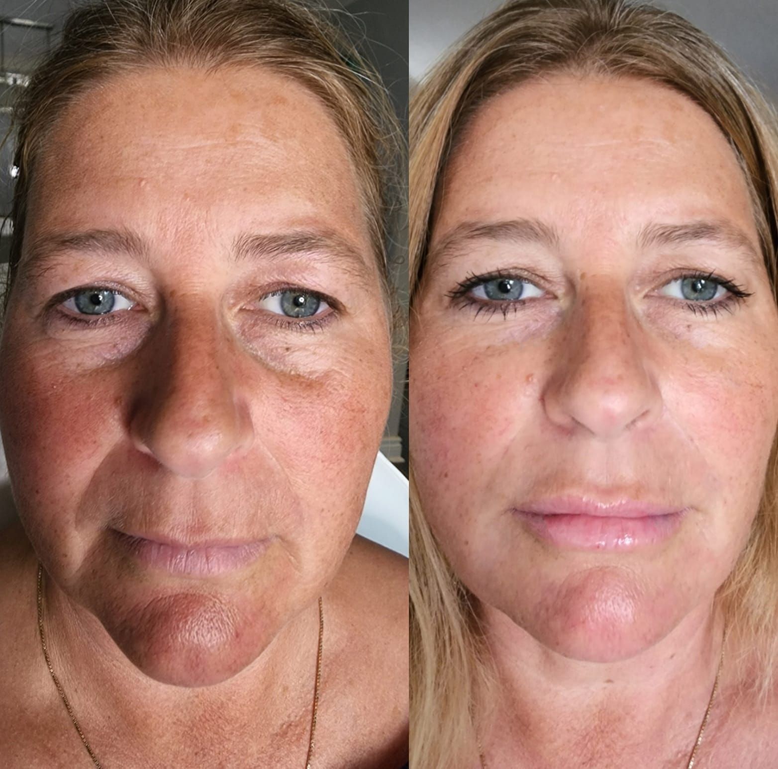 Before and after photos of a woman's face; left shows aged skin with red spots; right shows smoother skin.