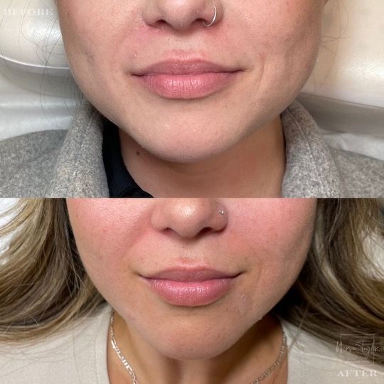 Before and after photos of a woman's face, showing smoother skin and fuller lips after a procedure.