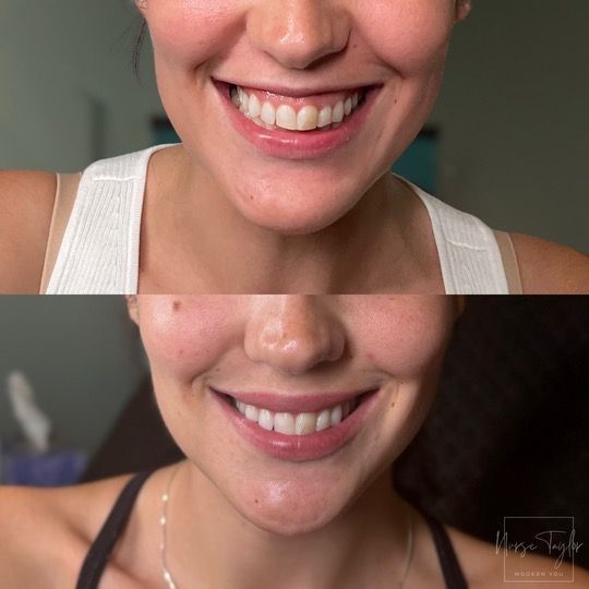 Side-by-side comparison of a person's smile before and after teeth whitening. Whiter, brighter teeth in the after photo.