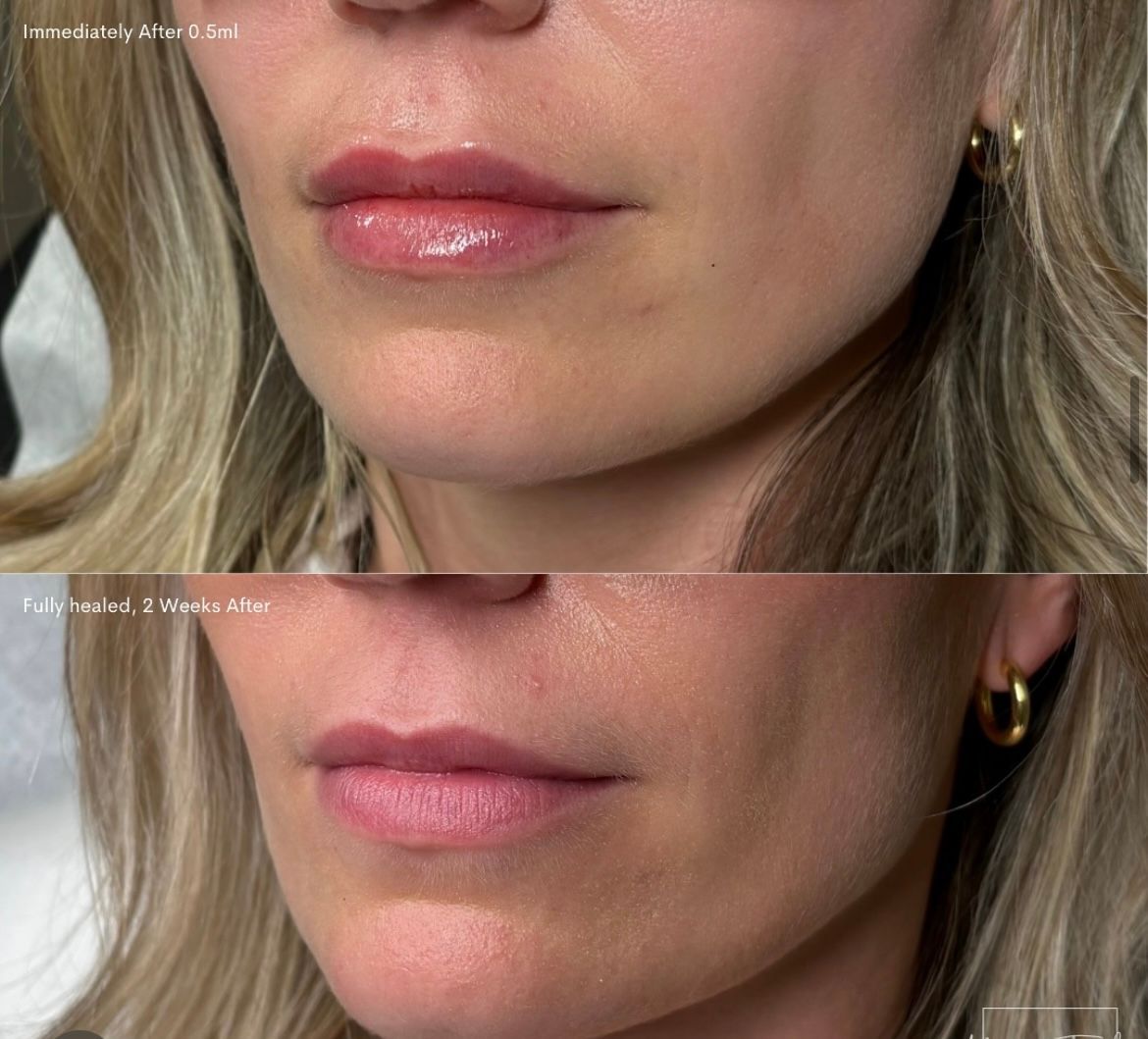 lip filler before and after burlington modern you medical aesthetics