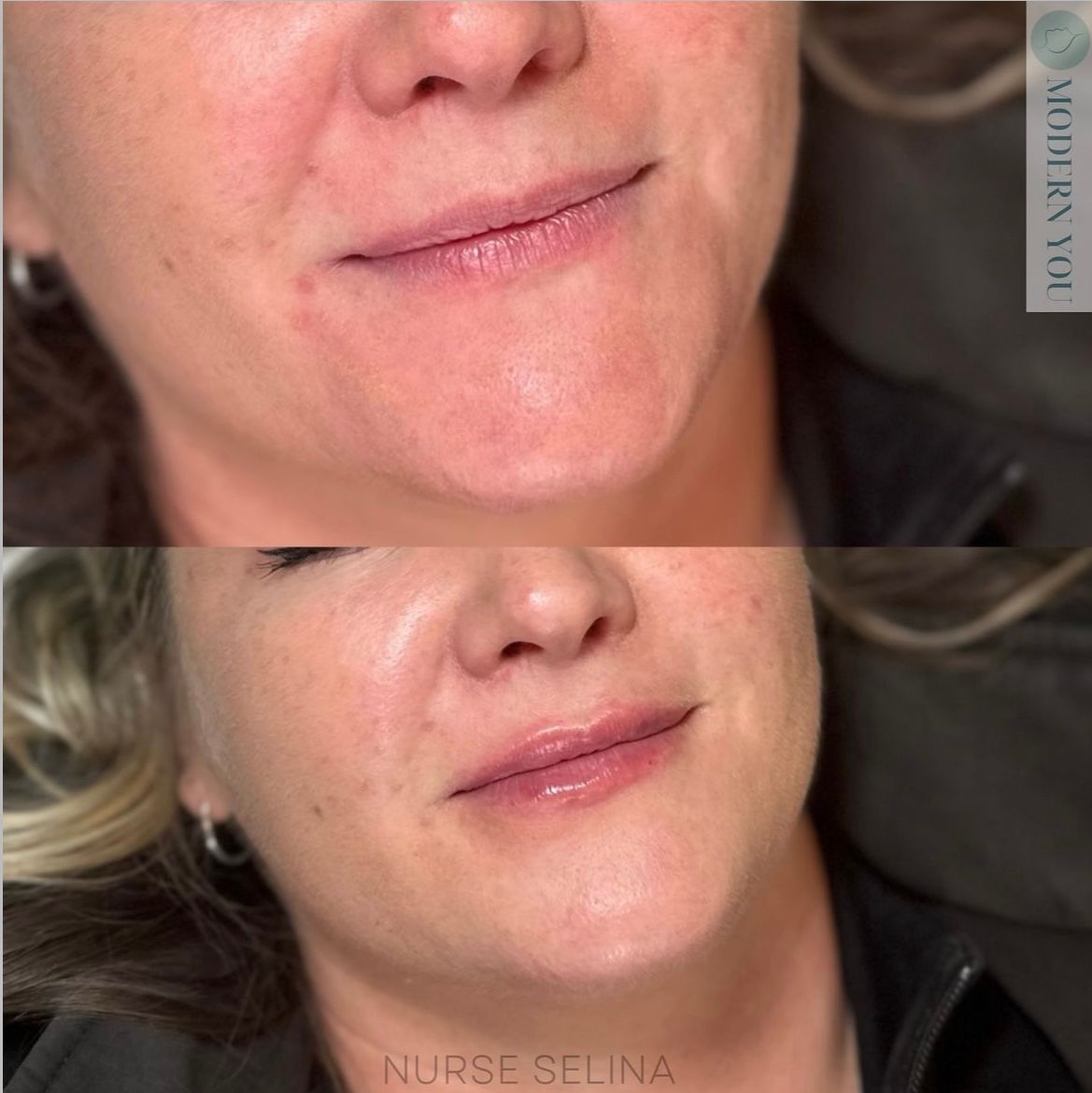 Side-by-side comparison of a woman's face before and after lip filler. Lips appear fuller in the after photo.