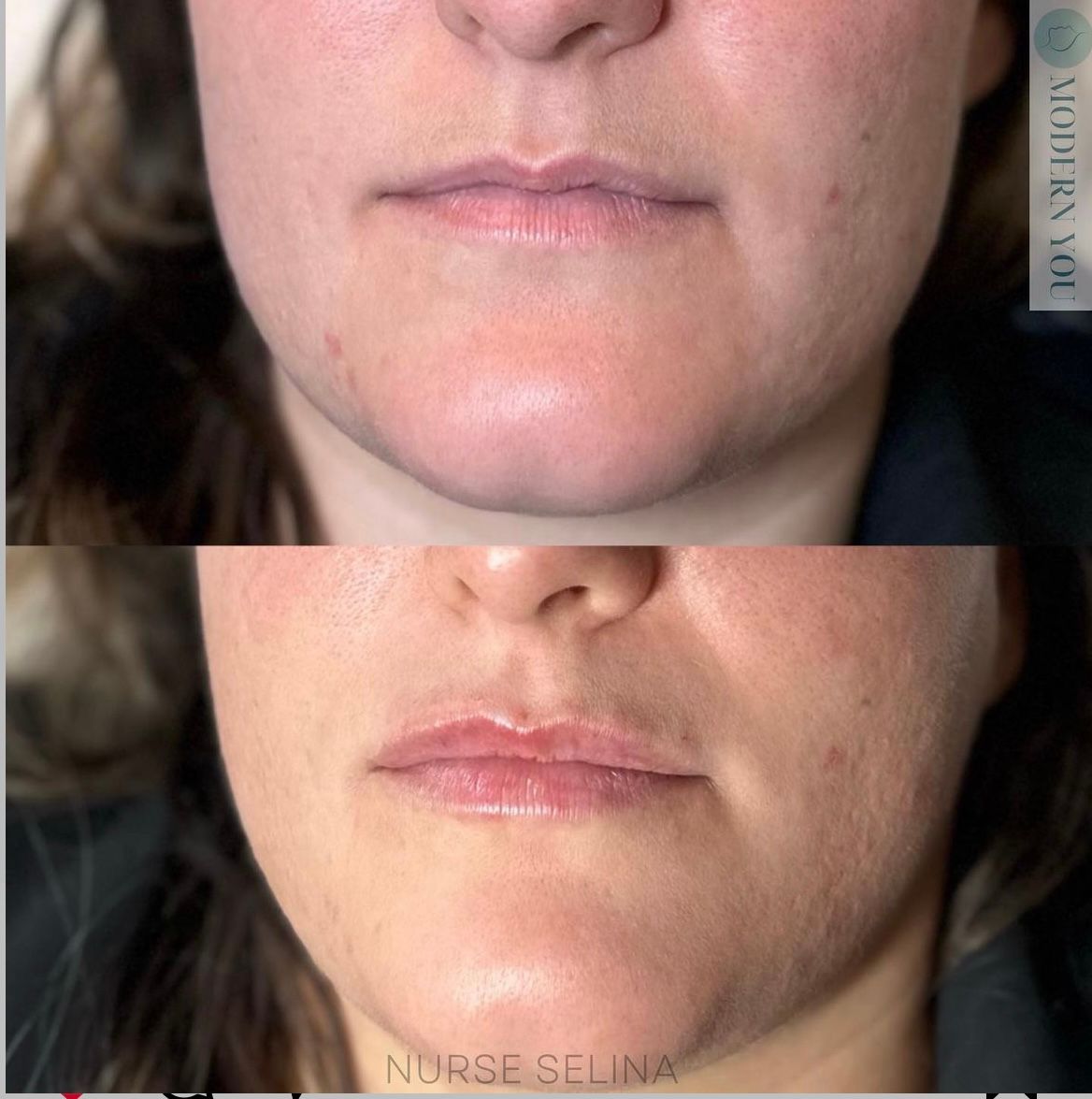 Before and after photos of a person's lower face, showing lip enhancement.