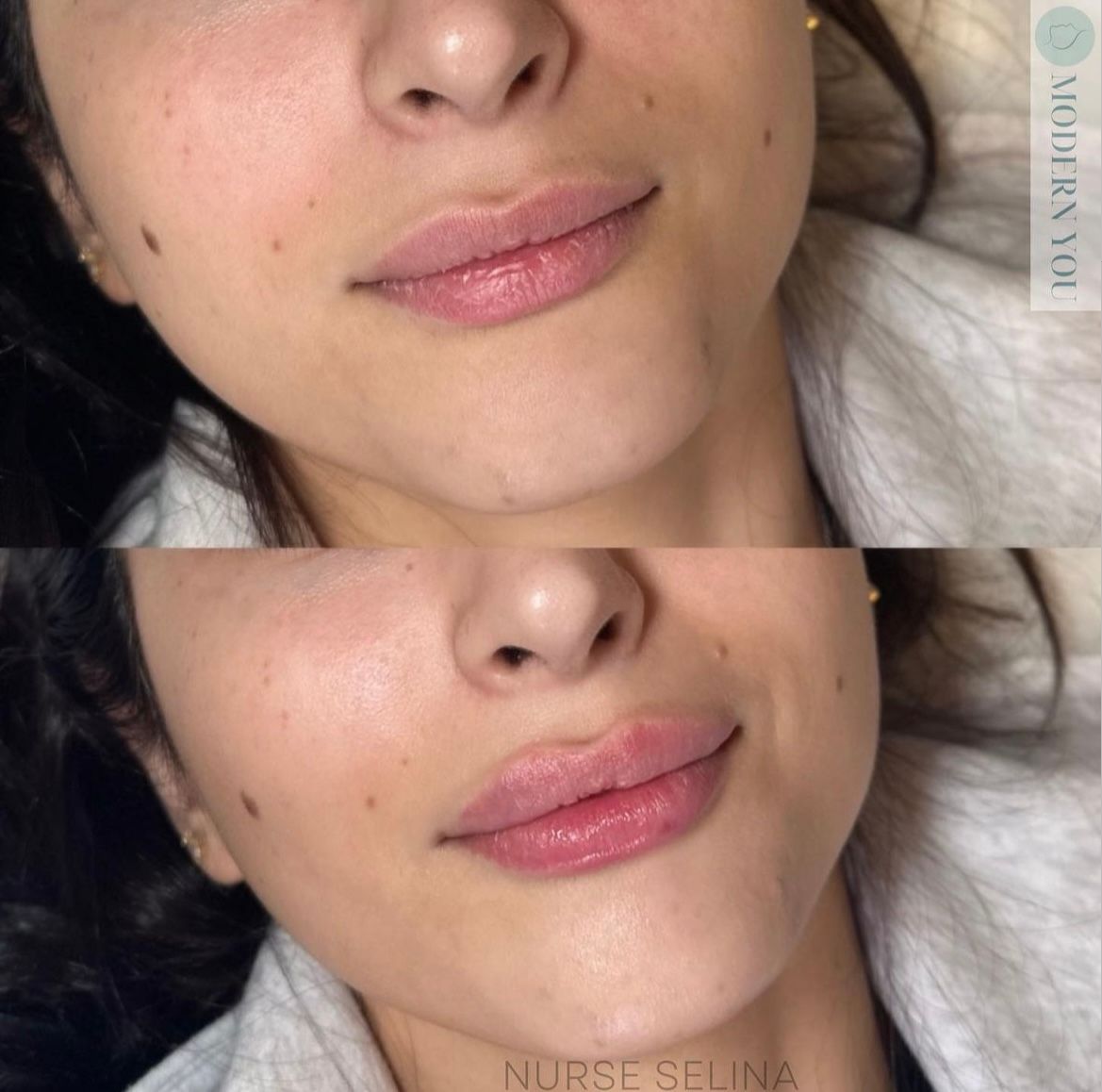 Before and after lip filler: woman's lips, bottom photo fuller, both angled and close up. Skin has small freckles.