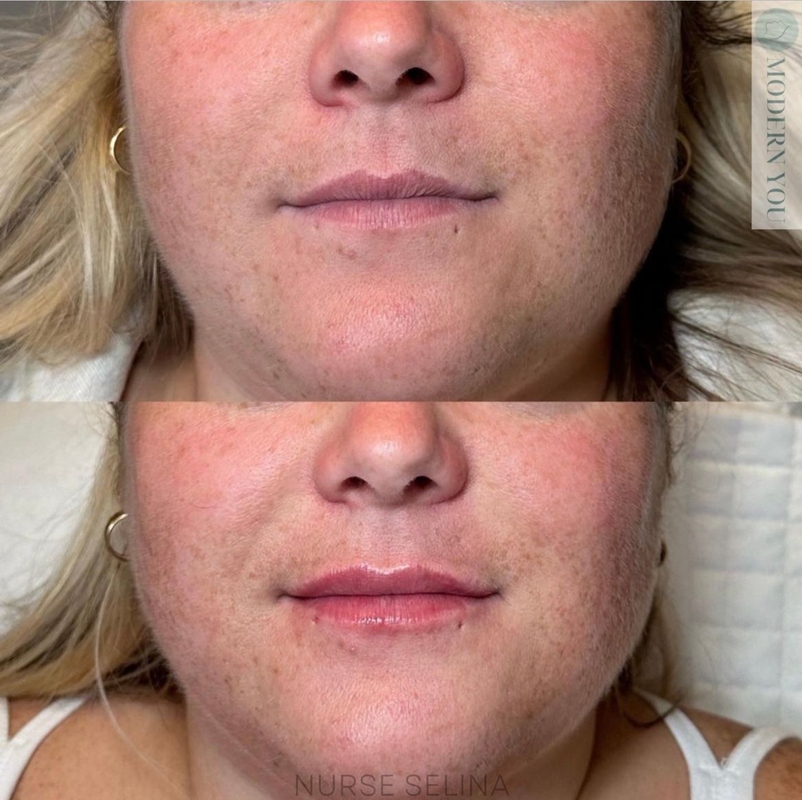 Before and after facial photos. Dark spots reduced, lips fuller. Caucasian woman.