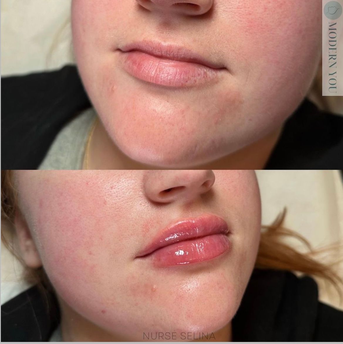 Before and after lip filler comparison: woman's lips appear fuller, with added gloss.