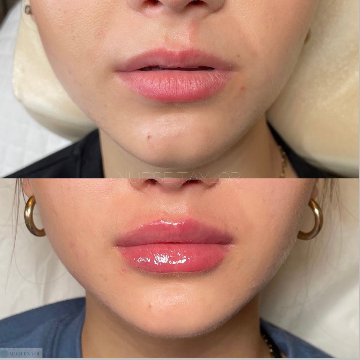 Before-and-after lip filler comparison: top - thin lips; bottom - plump lips with gloss.