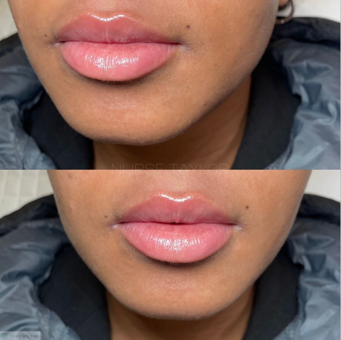 Before and after lips; full lips, gloss; dark skin tone.