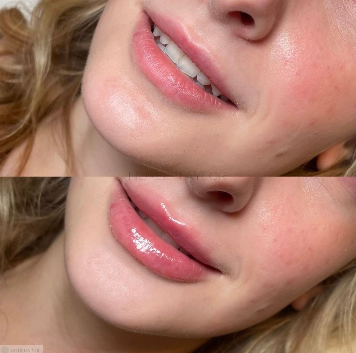 Before and after photos of a woman's lips. The bottom lip appears larger and glossier after the treatment.