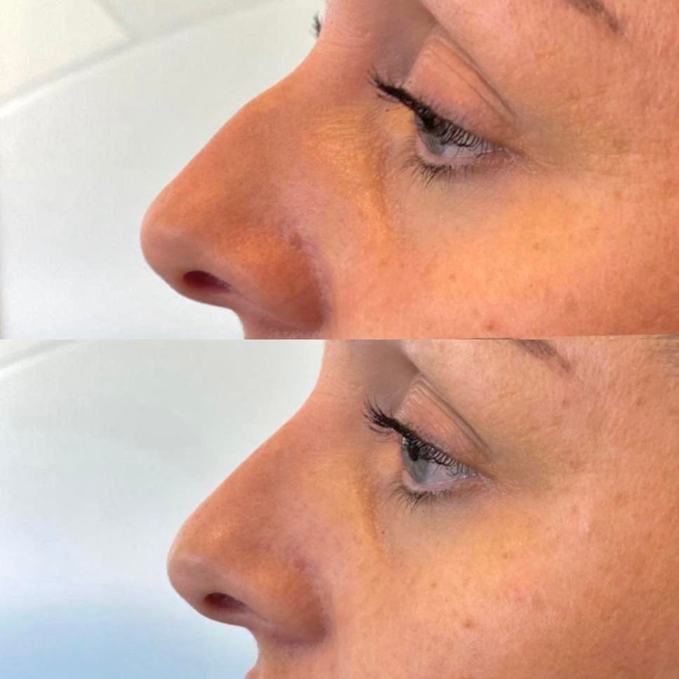 Before and after view of a woman's nose, showing non-surgical rhinoplasty results; side profile, fair skin.
