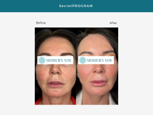 Side-by-side comparison of a person's face. Before photo shows wrinkles; after shows smoother skin and fuller lips.