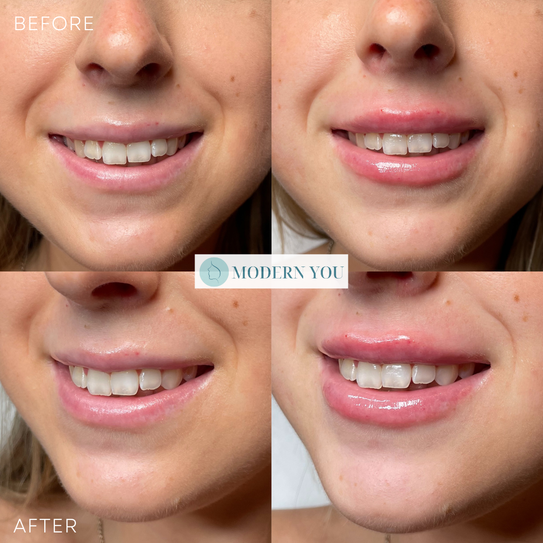 Before/After photos of a woman's lips. Increased lip fullness after cosmetic injections.
